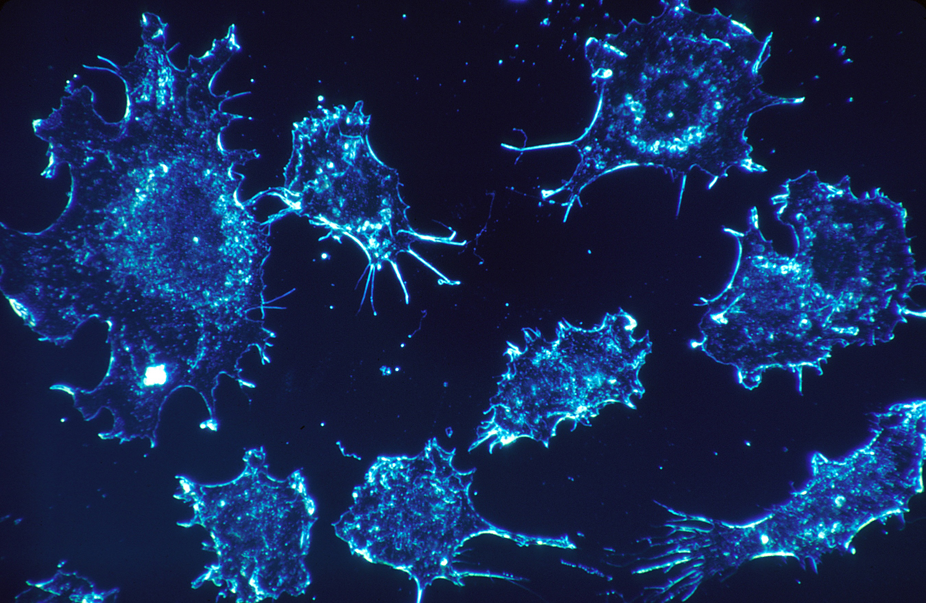 An extreme close-up view of cancer cells, tinted blue.